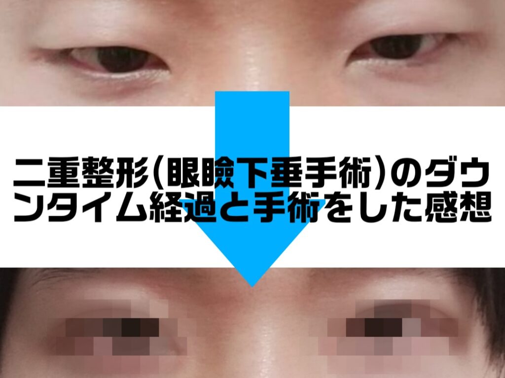 眼瞼下垂のbefore-after