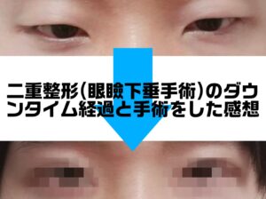 眼瞼下垂のbefore-after