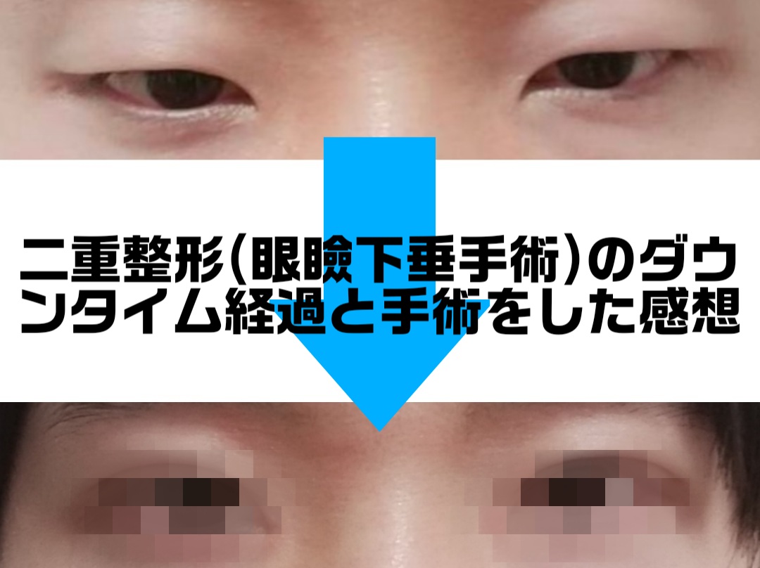 眼瞼下垂のbefore-after